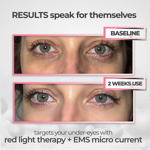 RevitalEyes™ Under-Eye Red Light Therapy