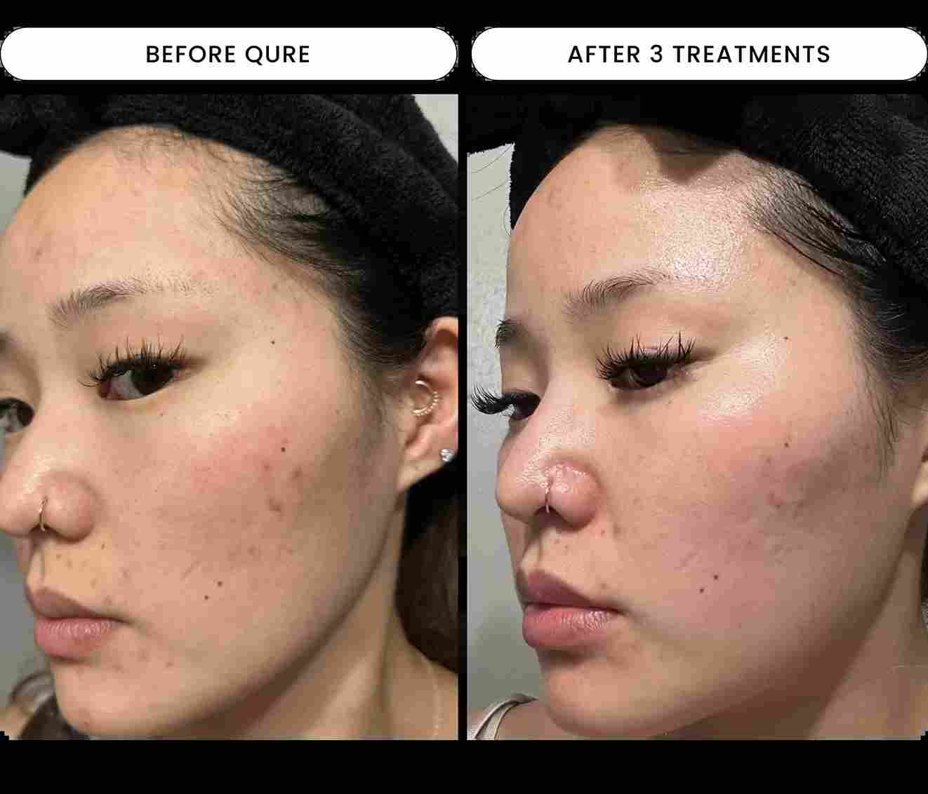 Micro-Infusion Facial System - For Dark Spot Novalight™
