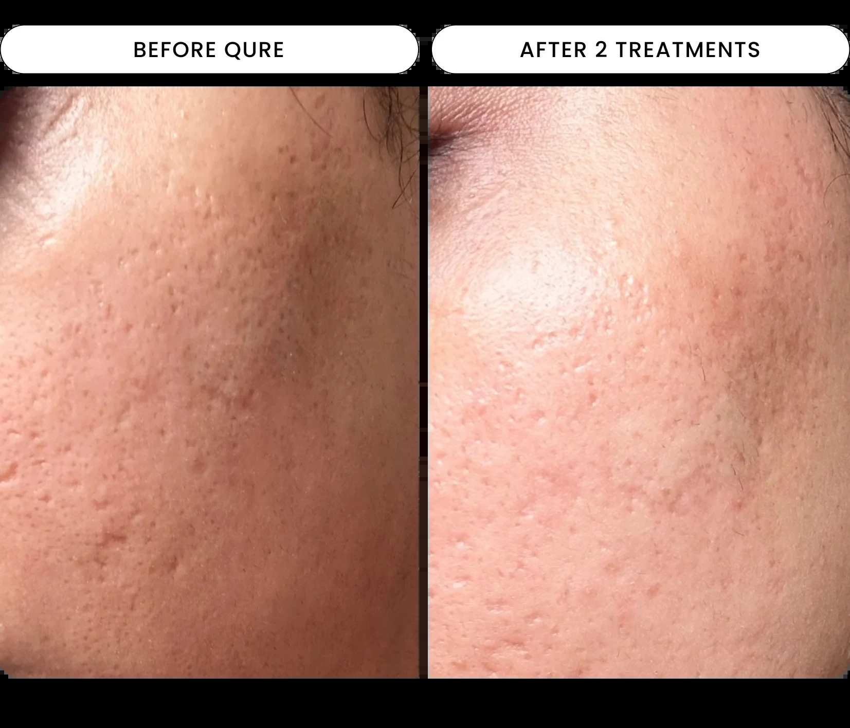 Micro-Infusion Facial System - For Dark Spot Novalight™ 