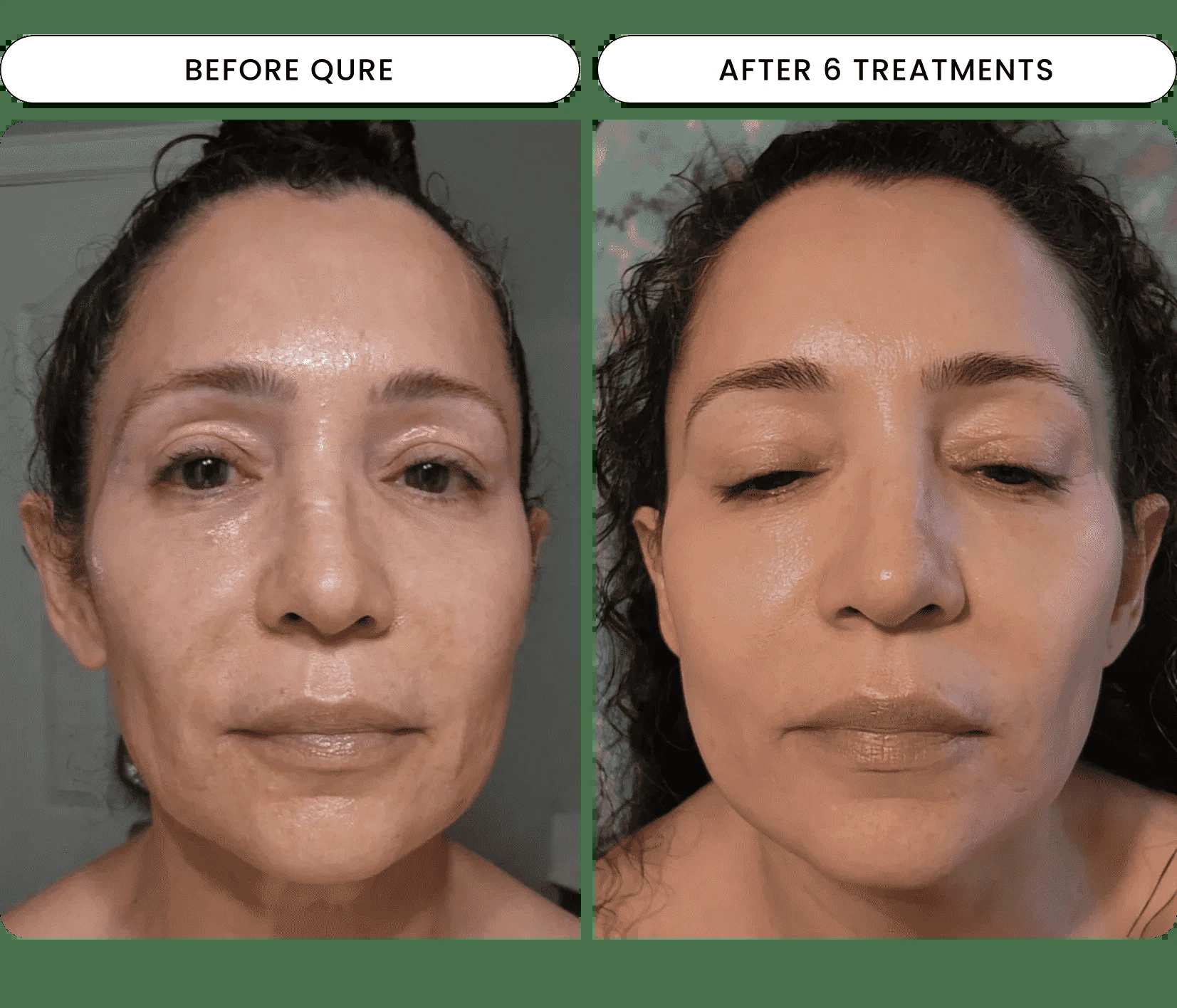 Micro-Infusion Facial System - For Dark Spot Novalight™ 